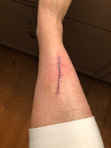 A stitched cut running down the customer's lower leg